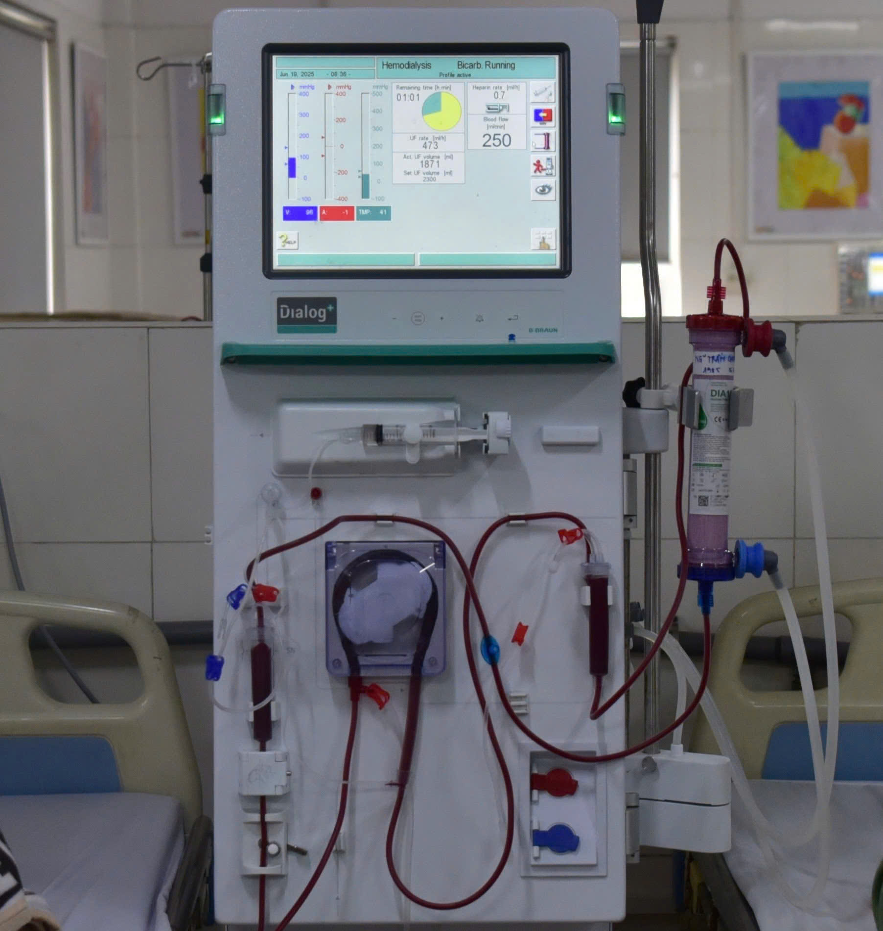 BỆNH VIỆN ĐA KHOA HOÀI ĐỨC ĐƯA VÀO SỬ DỤNG MÁY THẬN NHÂN TẠO THẾ HỆ MỚI, HƯỚNG TỚI THÀNH LẬP ĐƠN NGUYÊN THẬN NHÂN TẠO